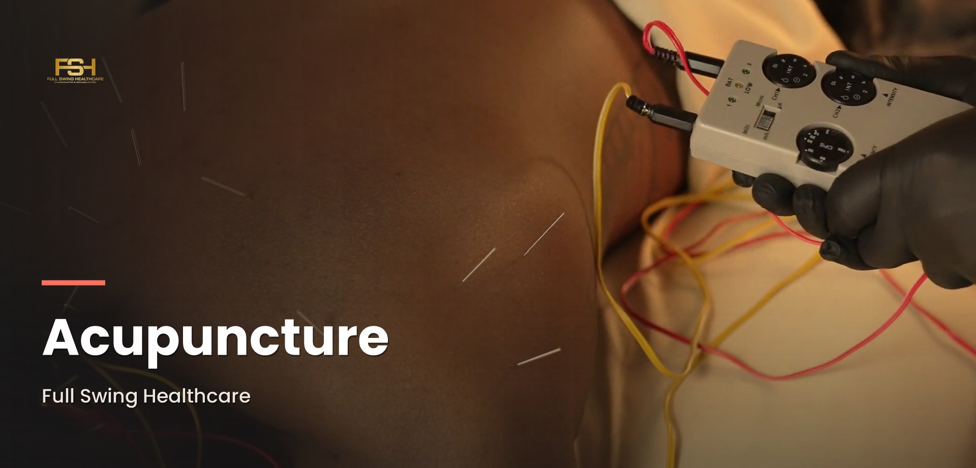 Acupuncture treatment at Full Swing Healthcare in Jacksonville, FL