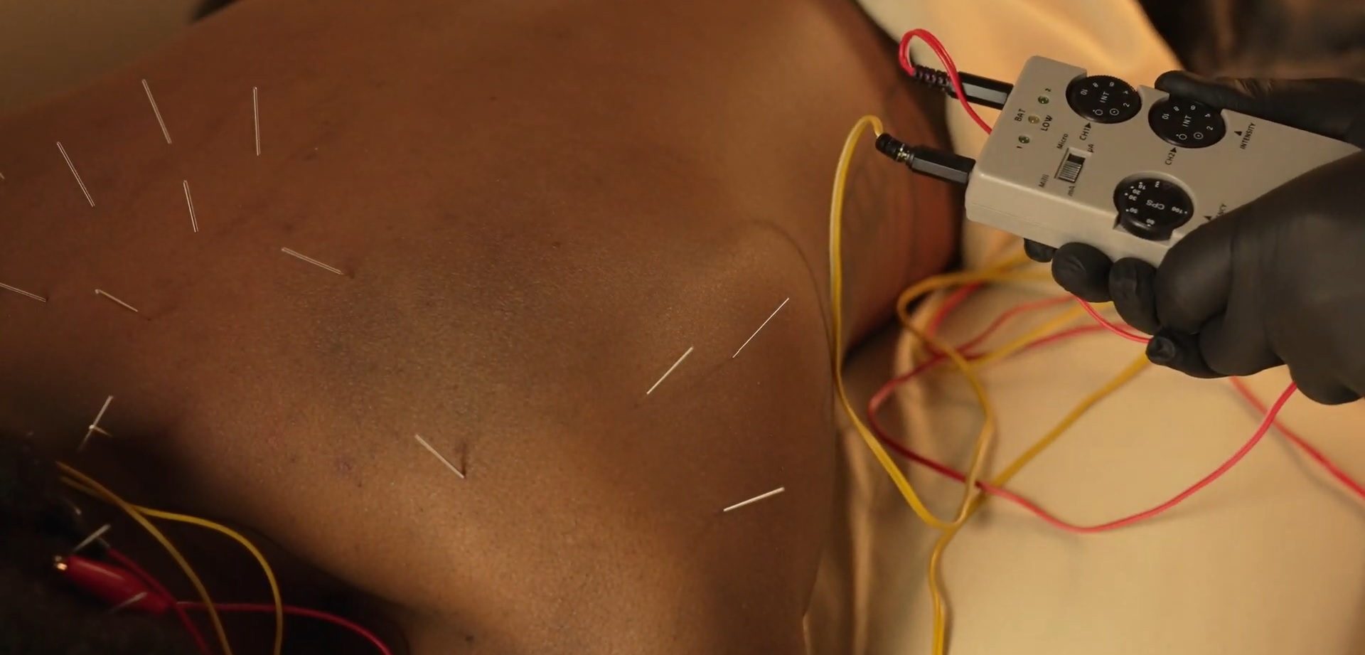 Acupuncture with electro-stimulation at Full Swing Healthcare in Jacksonville, FL