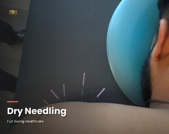 Dry needling treatment at Full Swing Healthcare in Jacksonville, FL