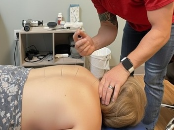 Acupuncture needles placed along the upper back at Full Swing Healthcare in Jacksonville, FL