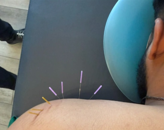 Dry needling on a patient's shoulder in Jacksonville
