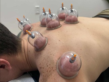 Myofascial cupping on a patient's back in Jacksonville